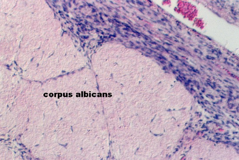 corpus albicans3.jpg (87811 bytes)
