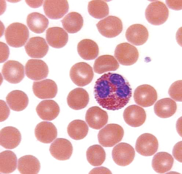 eosinophil3.JPG (41989 bytes)