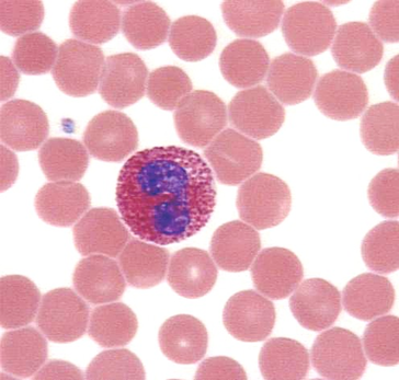eosinophil4.JPG (41491 bytes)